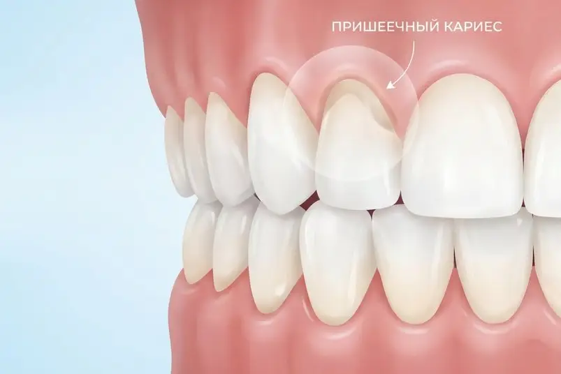 Пришеечный кариес у шейки переднего зуба возле десны